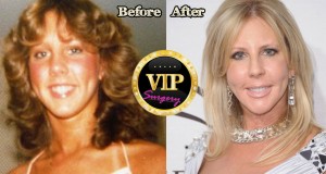 Vicki Gunvalson Plastic Surgery