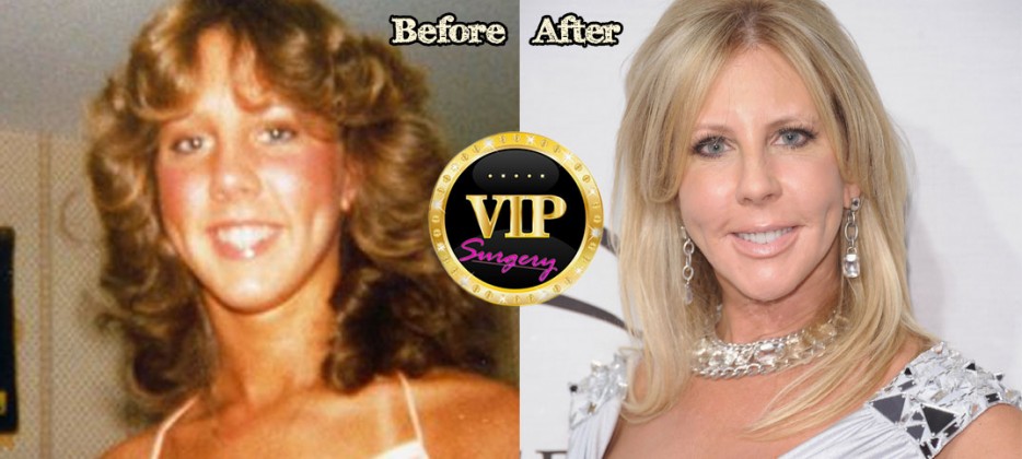 Vicki Gunvalson Plastic Surgery Before And After Photos