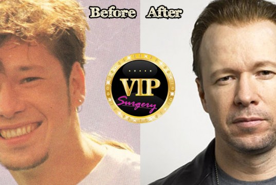 Donnie Wahlberg Plastic Surgery