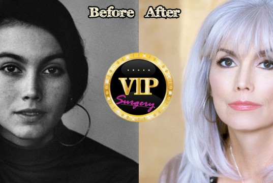 Emmylou Harris Plastic Surgery