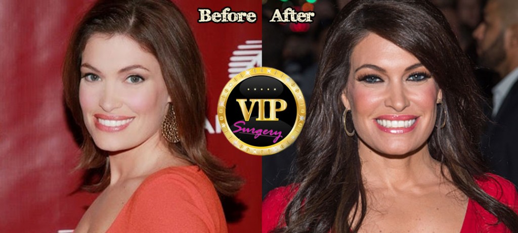 Kimberly Guilfoyle Plastic Surgery Before and After Pictures