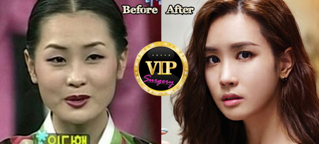 Lee Da Hae Plastic Surgery Before And After Pictures
