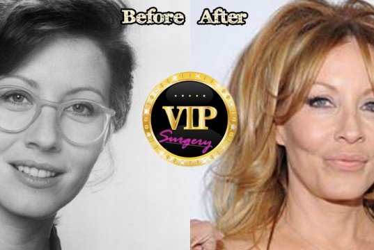 Linda Kozlowski Plastic Surgery