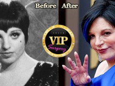 Liza Minnelli Plastic Surgery