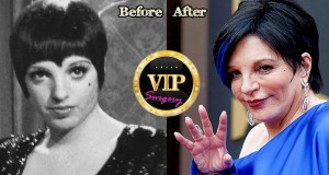 Liza Minnelli Plastic Surgery