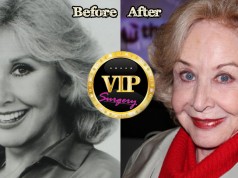 Michael Learned Plastic Surgery