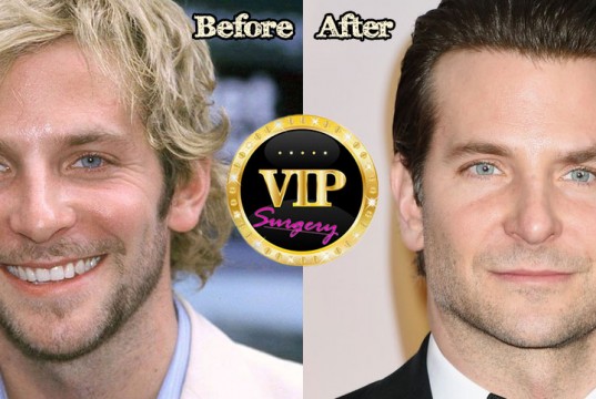 Bradley Cooper Plastic Surgery