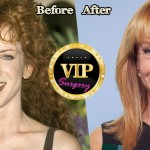 Kathy Griffin Plastic Surgery