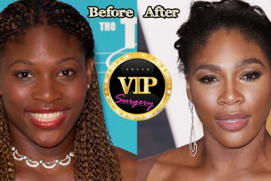 Serena Williams Plastic Surgery